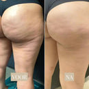 SmoothCurve Anti-Cellulitis Roller